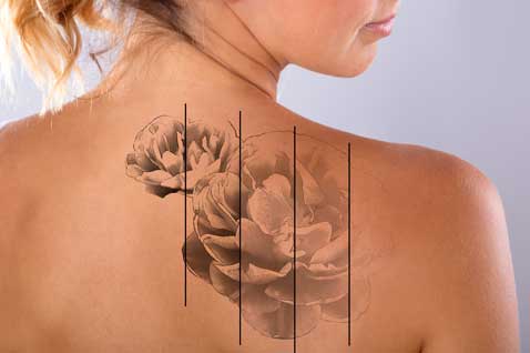 Tattoo Removal St. John's NL