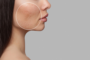 scar removal